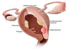 endomitrio